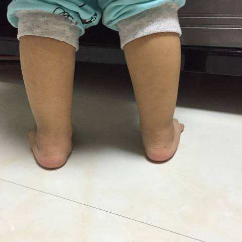 3岁足外翻到底要不要干预,儿童足外翻要早干预吗