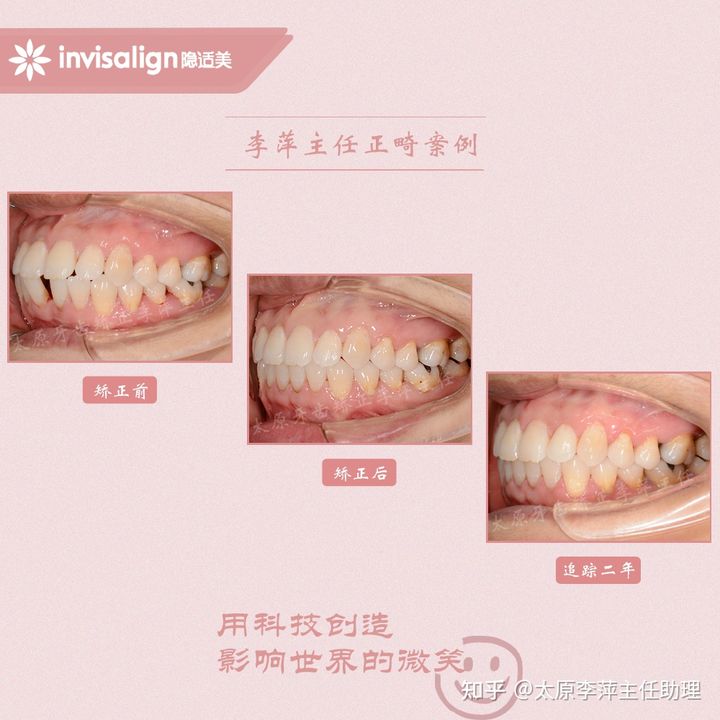 太原市牙齿正畸,太原市口腔正畸