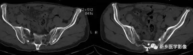 腹部平片能看到结石吗,腹部高密度结节影是什么