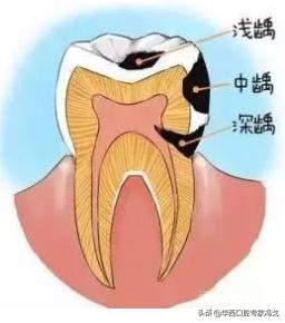 门牙龋坏了建议补牙还是做牙冠,龋坏补牙了还会坏吗
