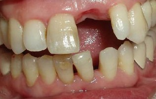 上门牙磕破了一小块怎么办,上门牙磕掉了怎样处理伤口