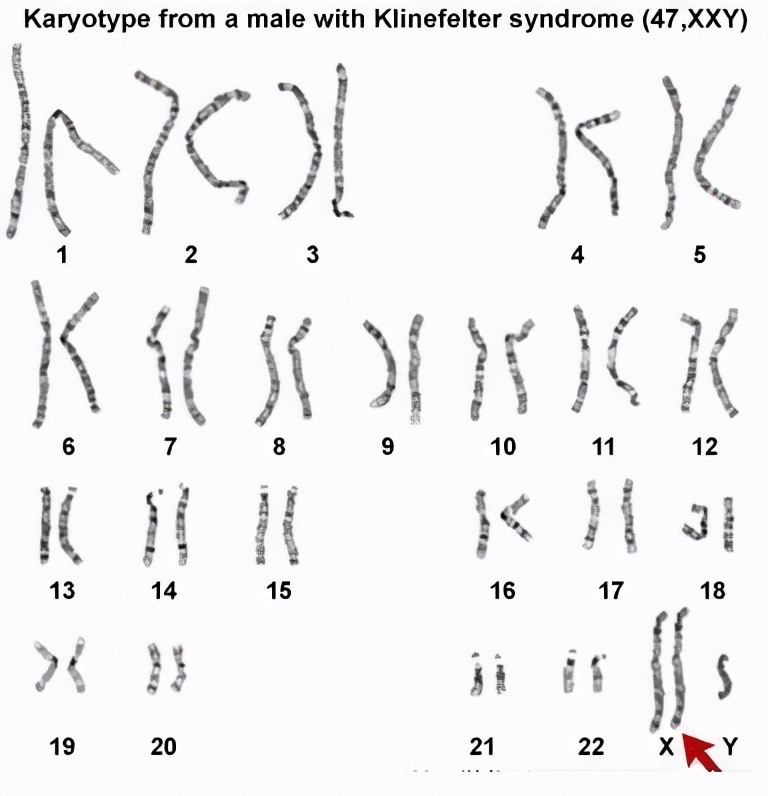 五十一岁女子被证明是男性,51岁女子被医学证明是男生