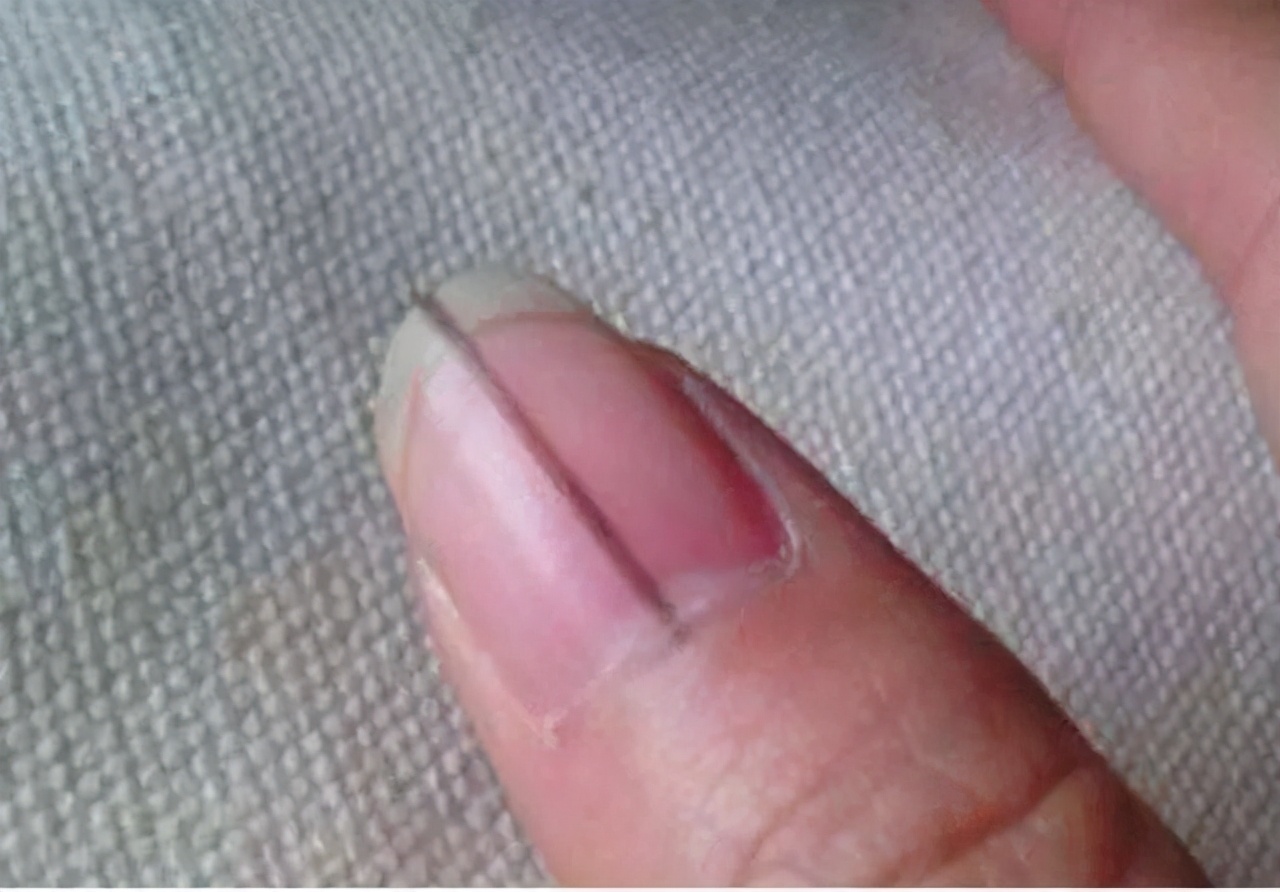 指甲易中空应该补充什么营养,手脚指甲凹凸不平是缺少什么营养