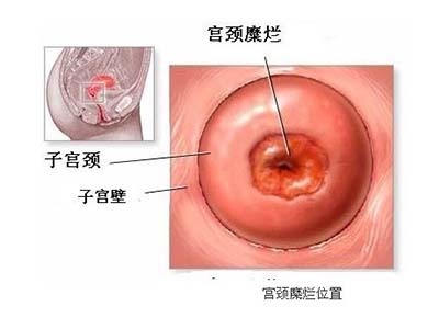 宫颈糜烂严重吗有必要做手术吗,宫颈糜烂需不需要治