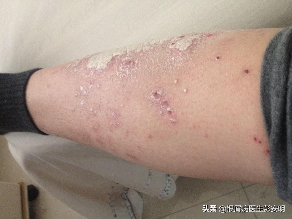 45岁男摘除扁桃体有什么危害,41岁扁桃体切除后后遗症