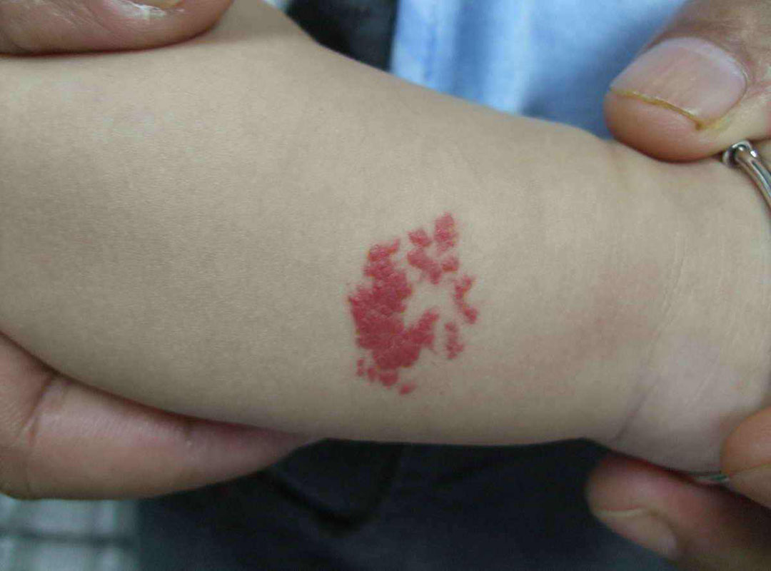 孩子因为胎记自卑怎么疏导,胎记会随孩子生长而长大怎么回事