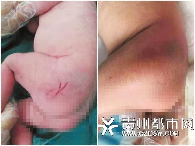 新生儿腰折家属索赔两百万,新生儿屁股受伤