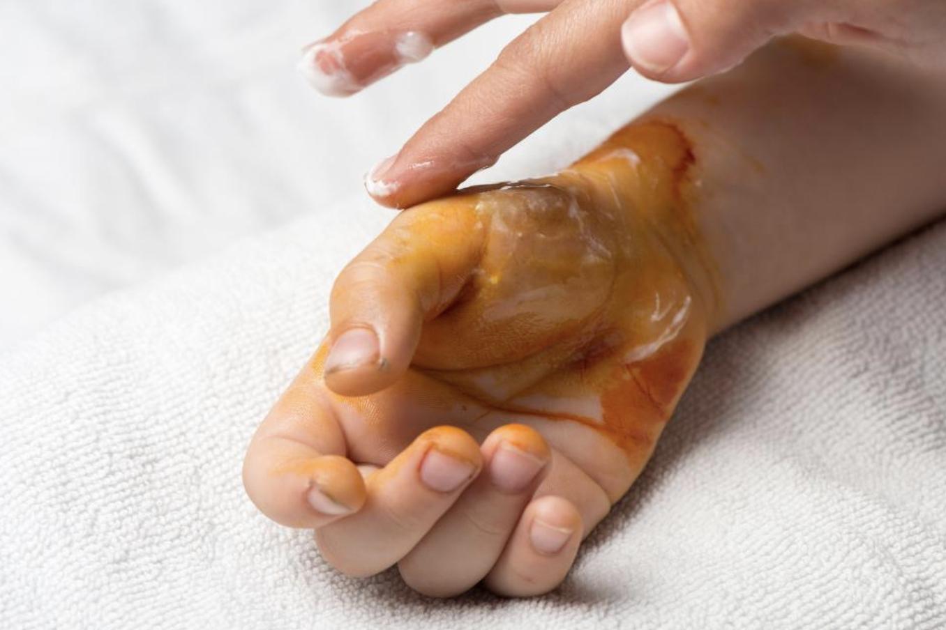 儿童烧伤去印痕的办法,儿童烧伤第1个24小时的补液量