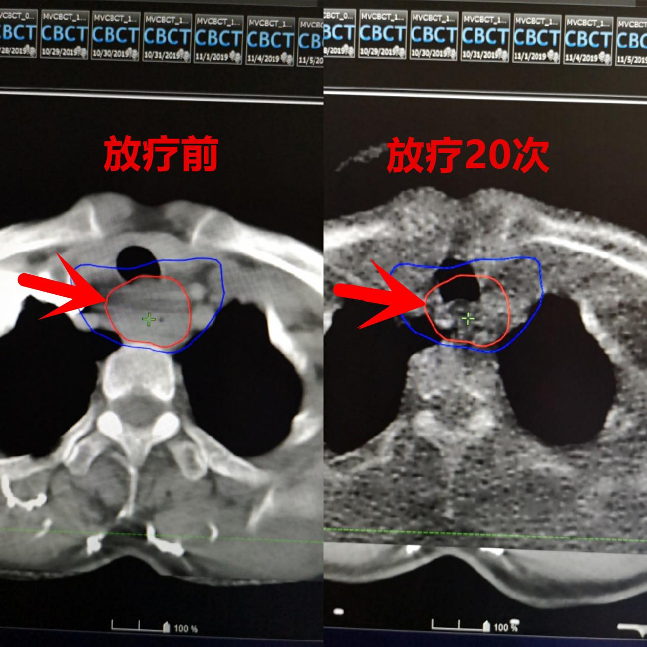肿瘤患者化疗后体重增加了,肿瘤病人术后康复体重上升好吗