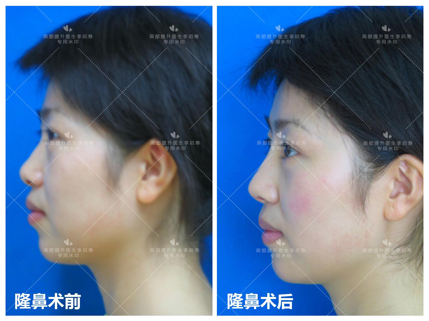 谈谈自己的整形经历,整形过来人经验分享