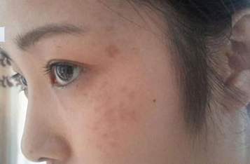 女性脸上暗黄有斑中药调理喝什么,中年女性脸上长斑用什么护肤品