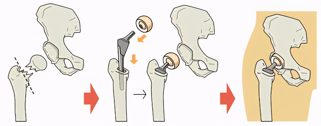 女性股骨头置换,股骨头坏死人工股骨头置换术过程