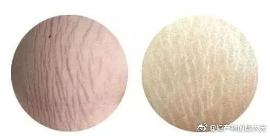 「今日陈大夫营业之」如何减少妊娠纹？