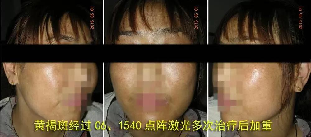 褐斑治疗,褐斑怎么办