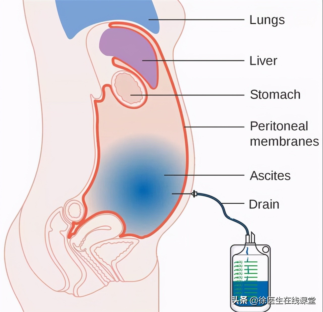 低蛋白引起的腹水的最好治疗方法,低蛋白引起肚子腹水怎么办