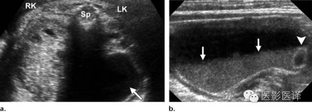 孕早期卵巢囊肿边界清形态规则,孕期卵巢囊肿呈液性伴点状回声
