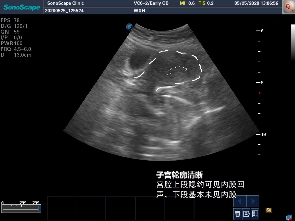 轻微宫腔粘连手术成功案例,轻度宫腔粘连分离术是大手术吗
