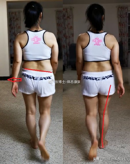 常见腿型矫正,长短腿矫正前矫正后对比