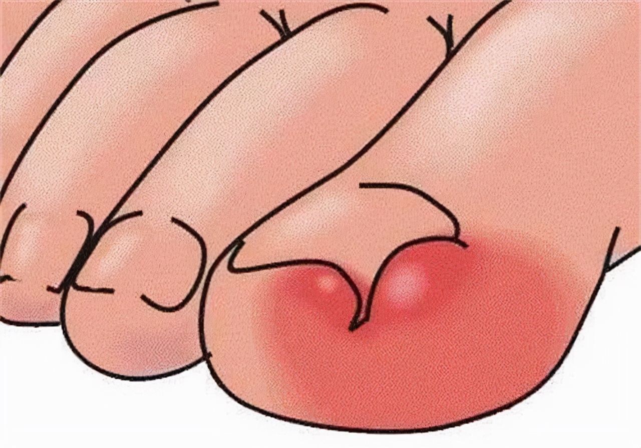 甲沟炎拔掉脚趾甲的过程,大脚趾甲重新长出来要多久