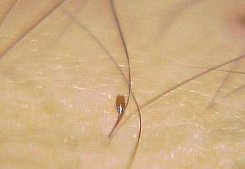 张医生讲传染疾病（一）：藏在男女私密部位的阴虱，最爱感染女性