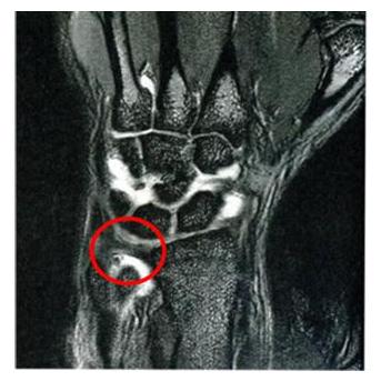 桡骨茎突腱鞘炎会误诊么,腱鞘炎容易与什么病误诊