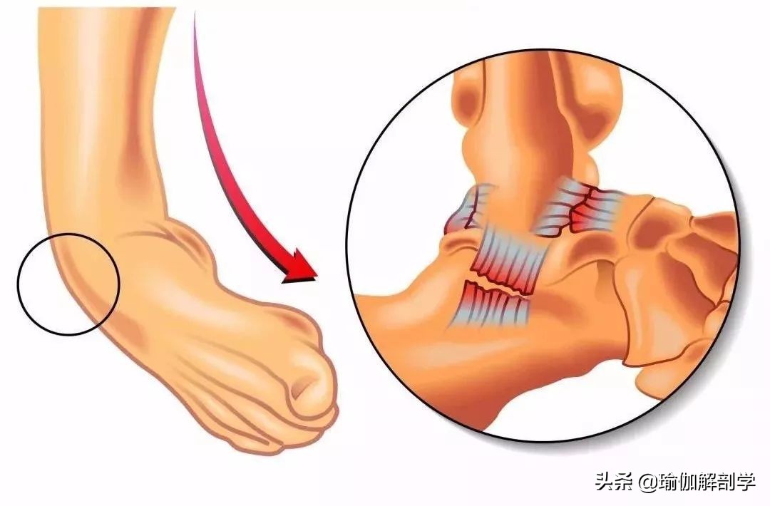 足踝稳定性差应该怎么练,扁平足怎么锻炼脚踝力量