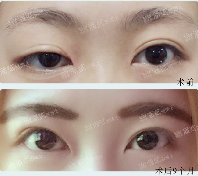 双眼皮修复有失败的吗,双眼皮修复失败了会怎样