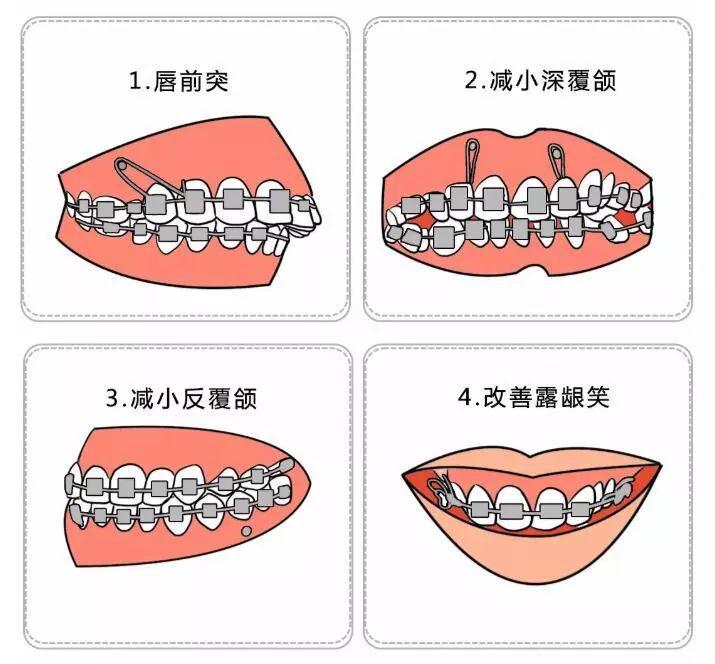 大连齿医生口腔补牙洞视频,口腔正畸打骨钉动画演示