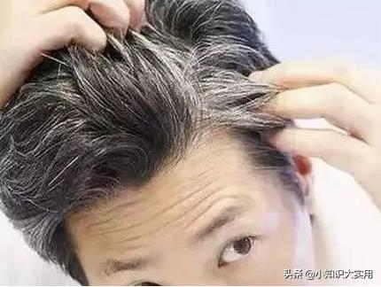 白发人群的福音,多吃什么可以有效的治愈白发