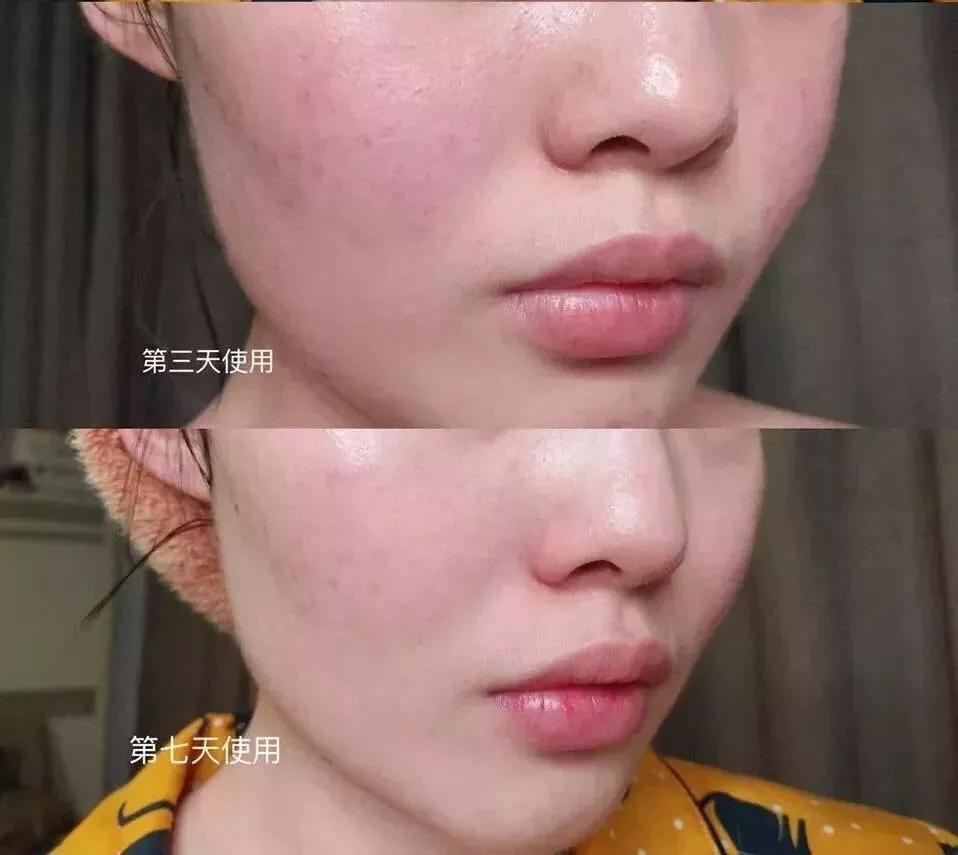 火遍日本的国产面膜,敷尔佳清痘面膜真实测评