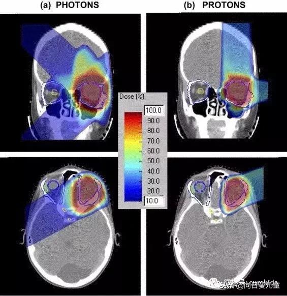 质子治肿瘤怎么样,儿童肿瘤质子治疗好吗