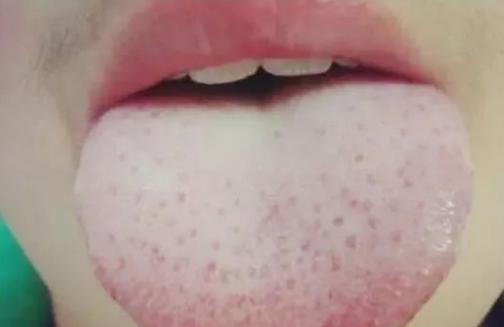 猩红热是皮肤病吗,猩红热样皮炎会传染吗