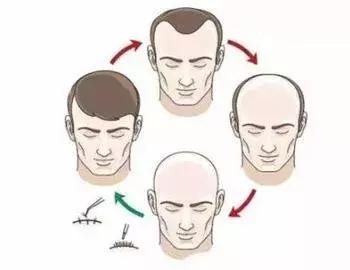 脱发严重去医院开什么药,轻微脱发要及时就医吗