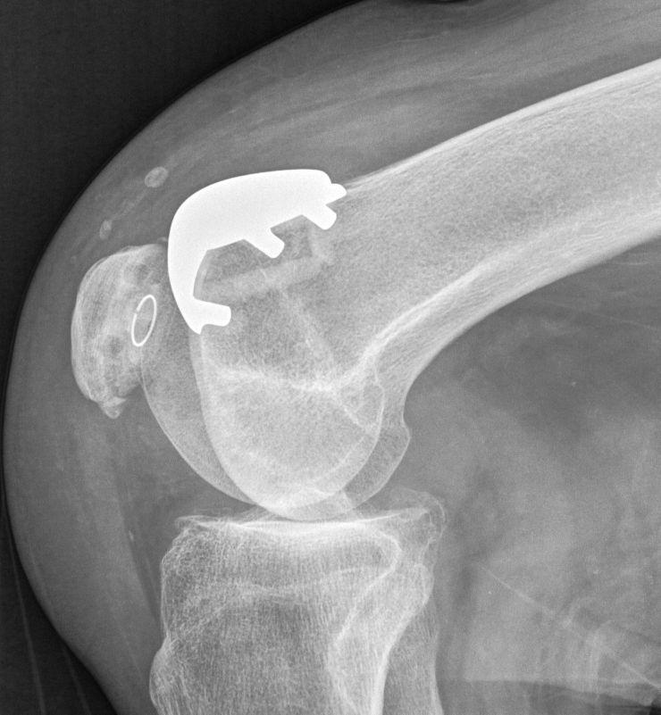 走平路上下楼膝盖疼怎么回事,膝盖下楼梯痛走平路也痛什么原因