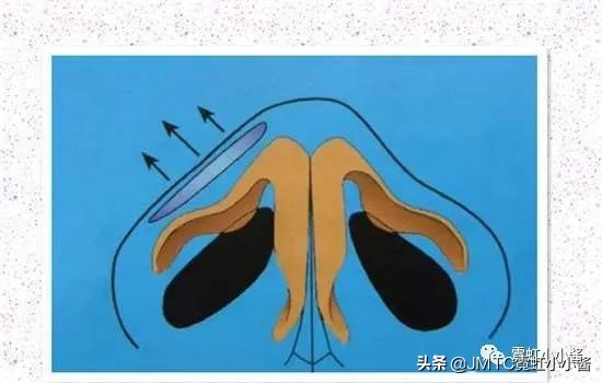 鼻子怎么修复好看呢,鼻型修复方法大全