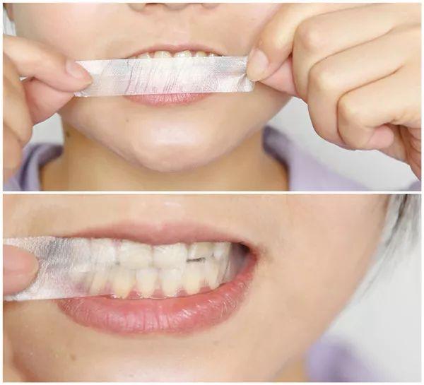 牙齿美白有这几种方法你了解多少,牙齿美白靠谱吗十年牙医告诉你