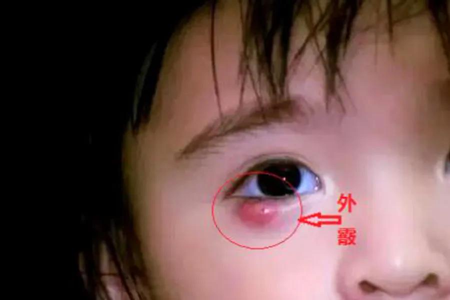 孩子长针眼自己在家怎么处理,小孩长针眼怎么治最快偏方