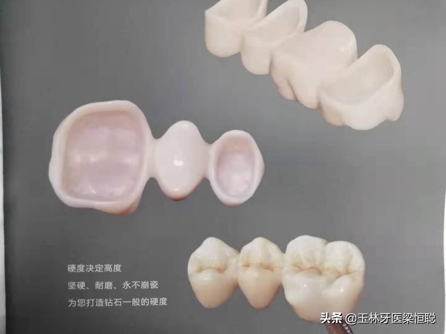 如何选择烤瓷牙牙冠,怎样选烤瓷全冠