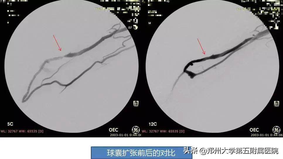科普关于动静脉瘘手术,动静脉瘘是怎么治疗最好