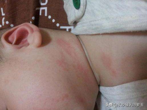 母乳宝宝容易奶粉过敏,母乳过敏一定要停掉母乳吗