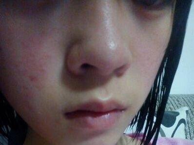 春天脸部发红敏感怎么修复,春天保护皮肤的正确方法