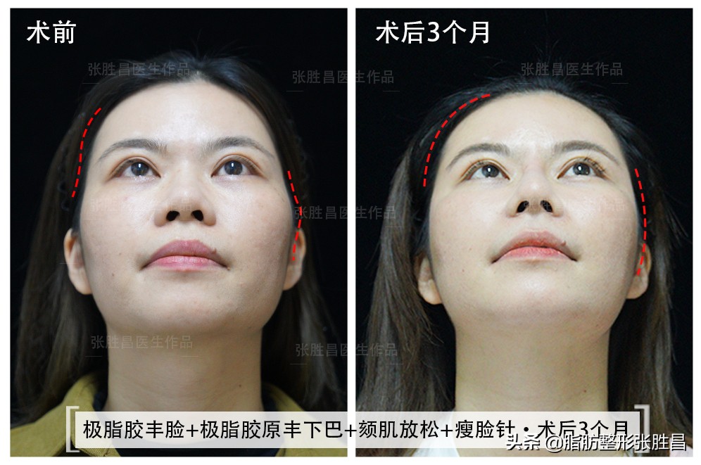 34岁广东女生，颧骨突出显刻薄苦相，脂肪填充后美成人间富贵花