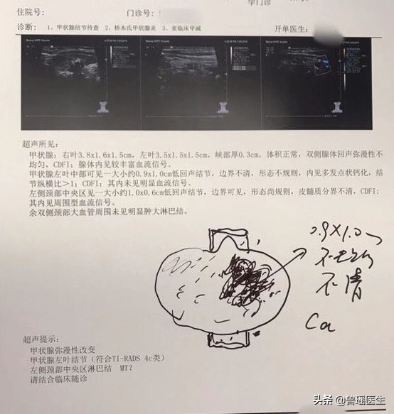 “大夫，我刚做完甲穿提示结节是良性，为什么还要让我做？”