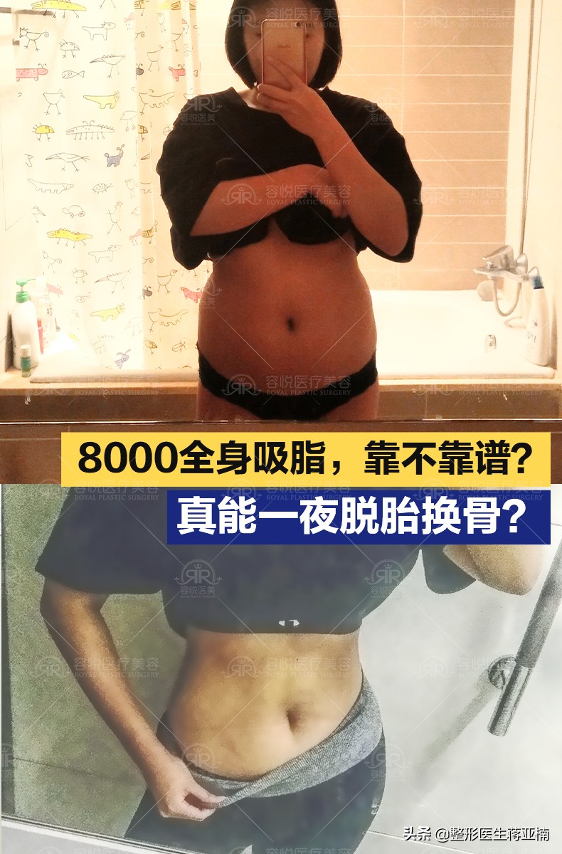 全身吸脂18斤需要多少钱,8000的面部吸脂