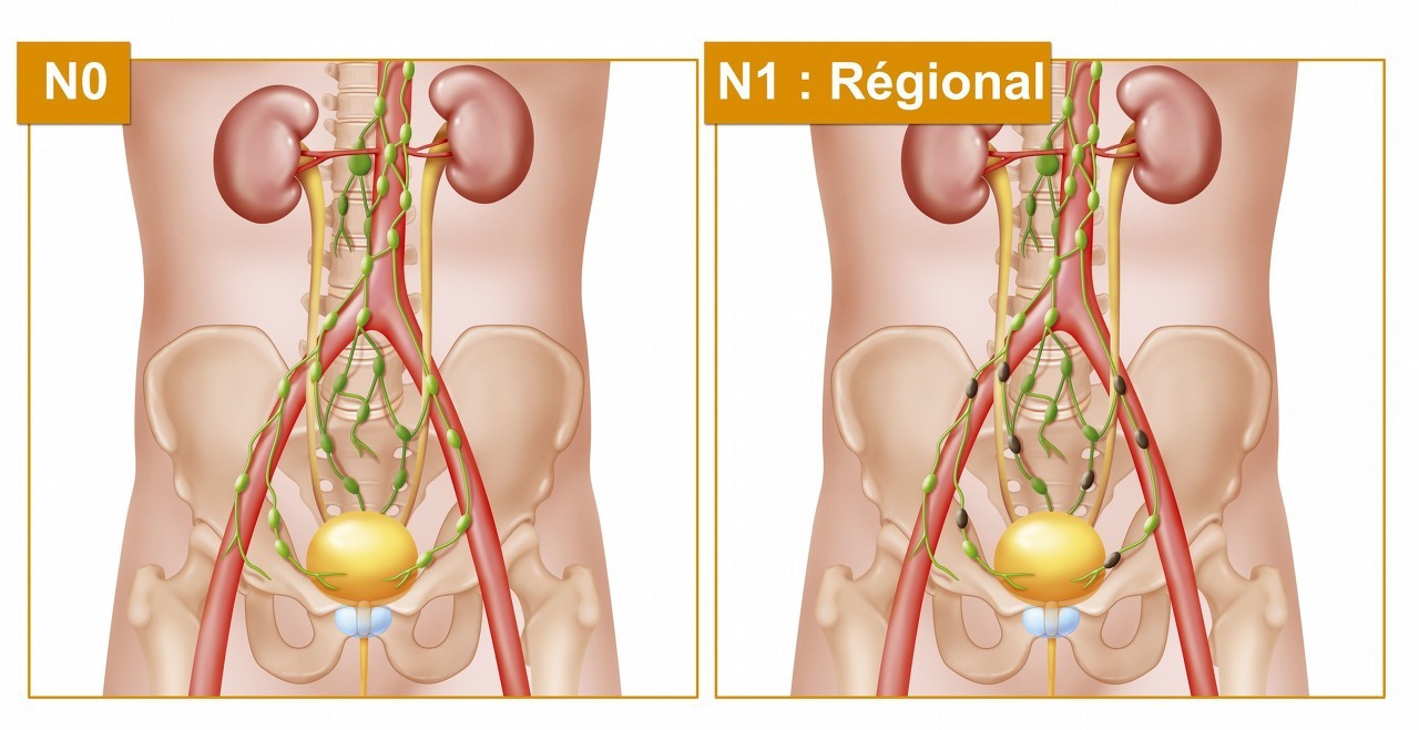 前列腺炎治疗保健,前列腺炎治疗保养