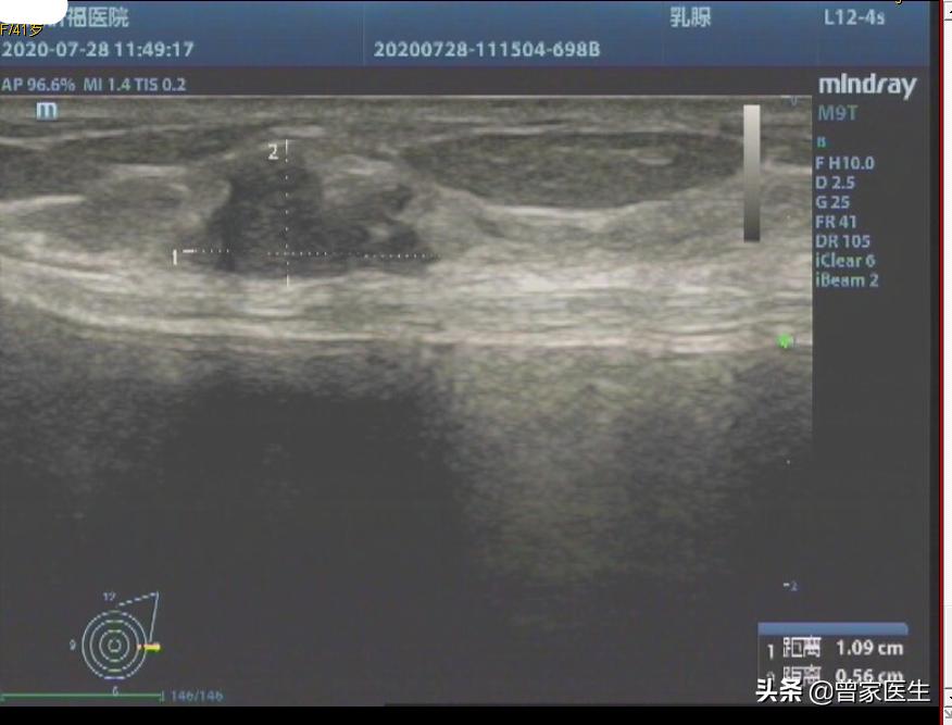 乳腺彩超4a报告单怎样描述的,乳腺彩超birads4a类严重吗