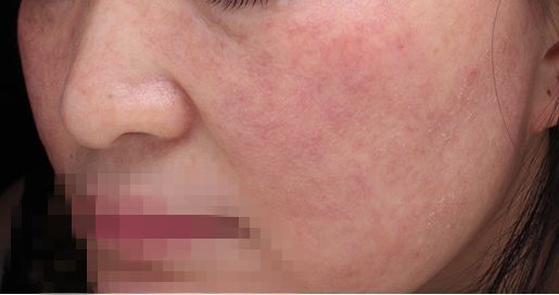 洗脸的时候脸颊刺痛发红,洗脸后脸发红是什么原理