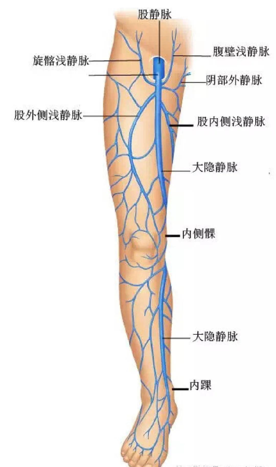 大隐静脉曲张原因,大隐静脉曲张手术