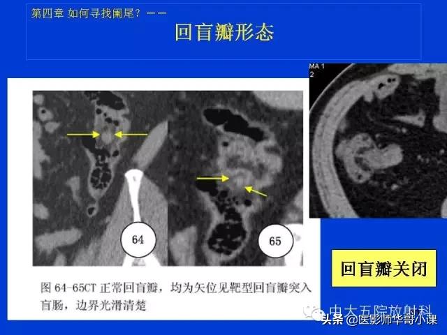 阑尾炎课件,阑尾炎的超声课件
