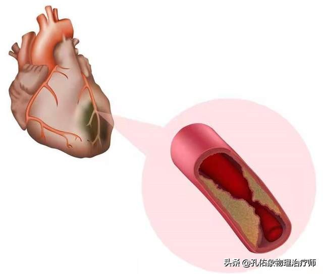 肩周炎肩膀疼是什么原因造成,肩周炎导致的肩膀疼痛怎么缓解
